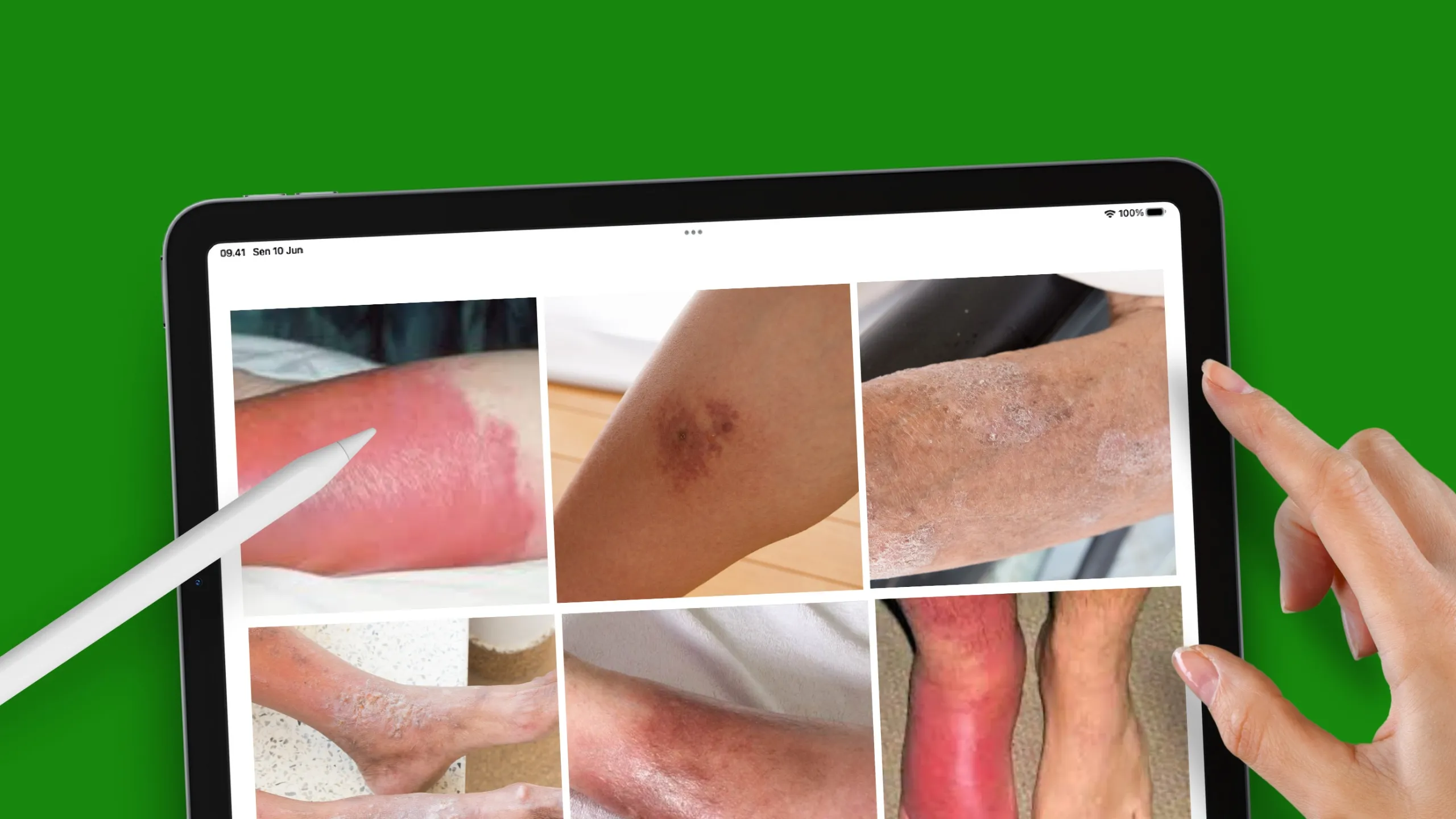 Selulitis pada Diabetes: Gejala, Risiko, dan Cara Mencegah Infeksi Luka | RUMAT